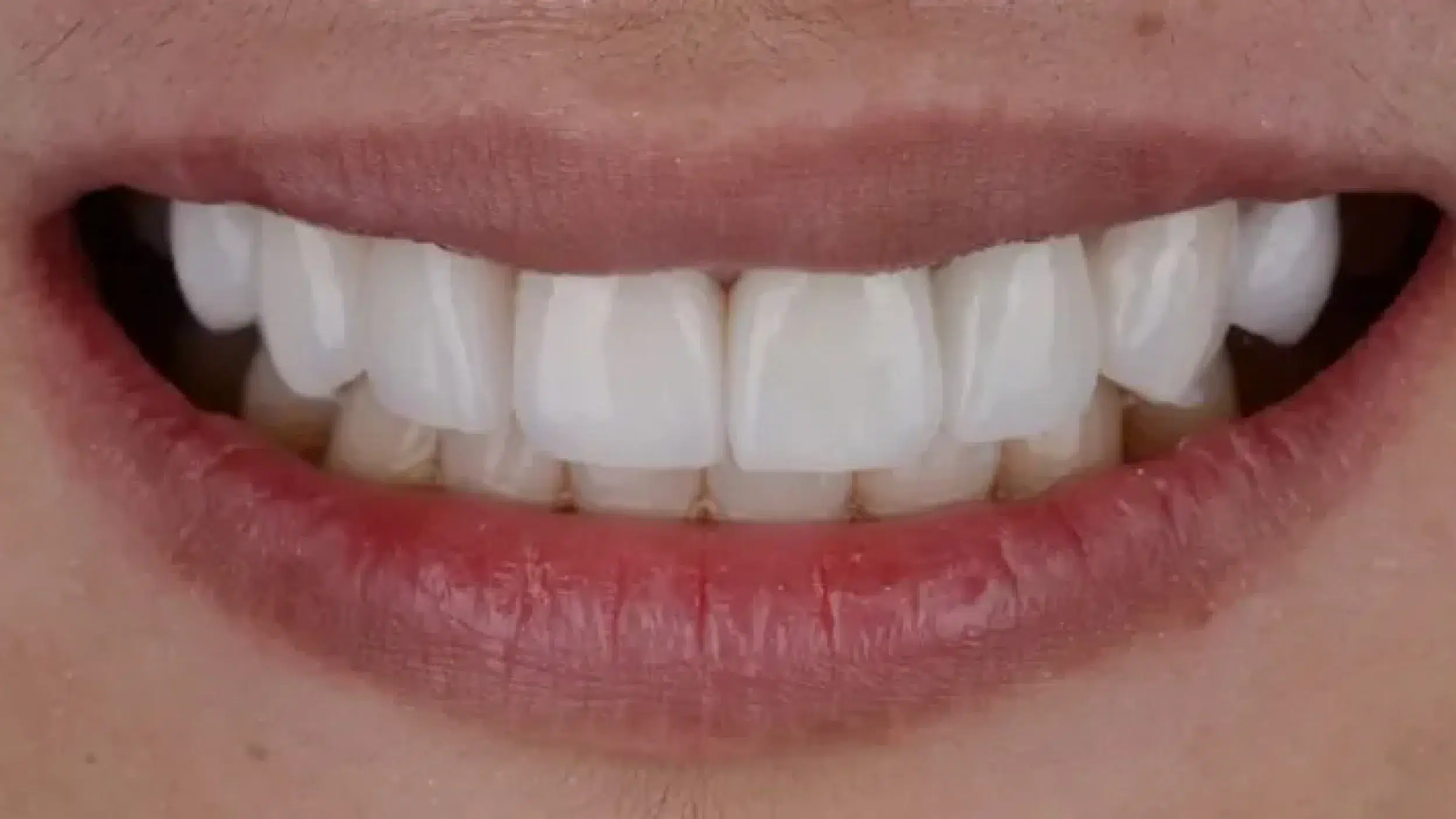 After-Veneers-New-1
