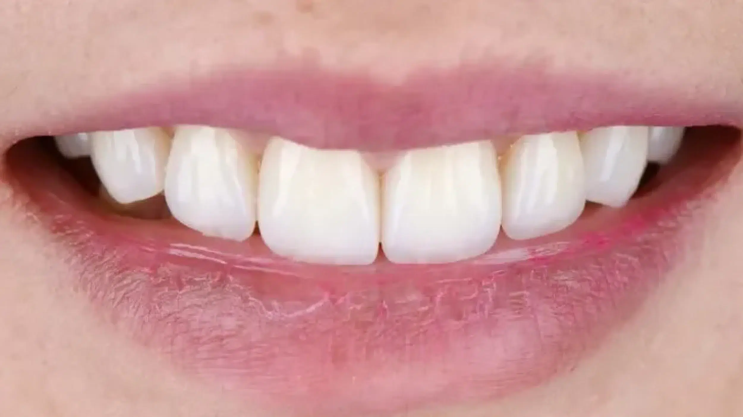 After-Veneers-New-2