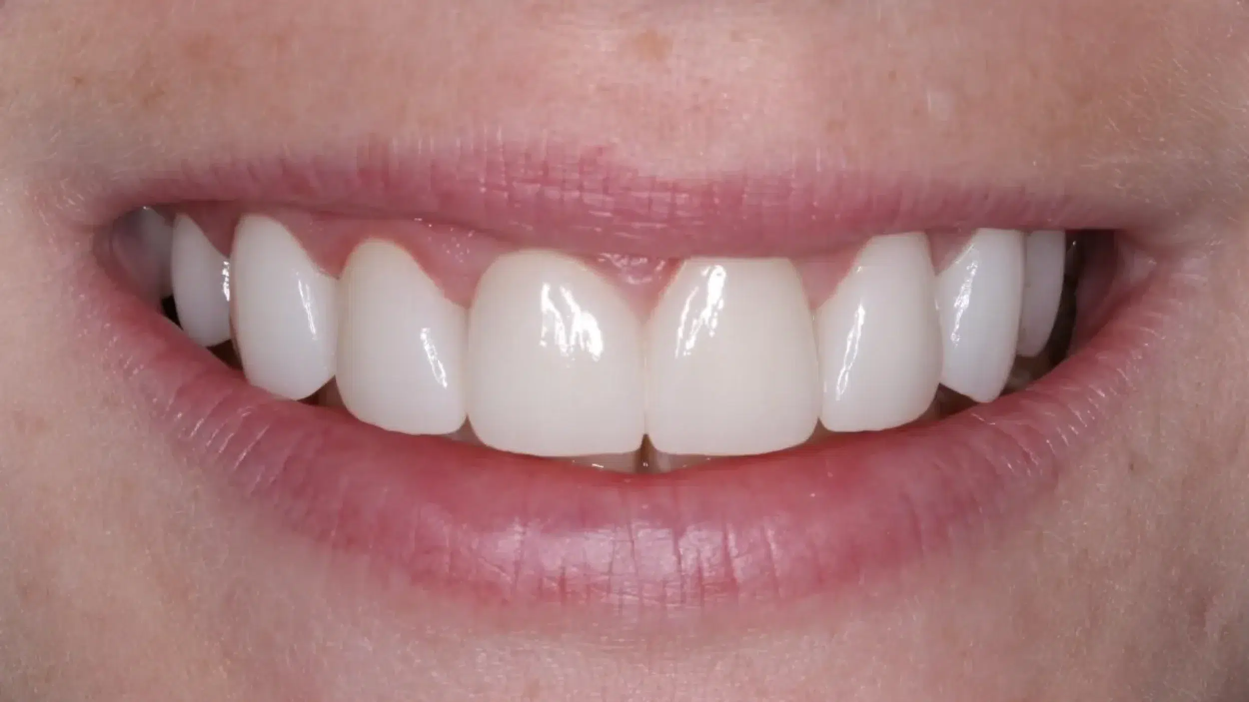 After-Veneers-New-3