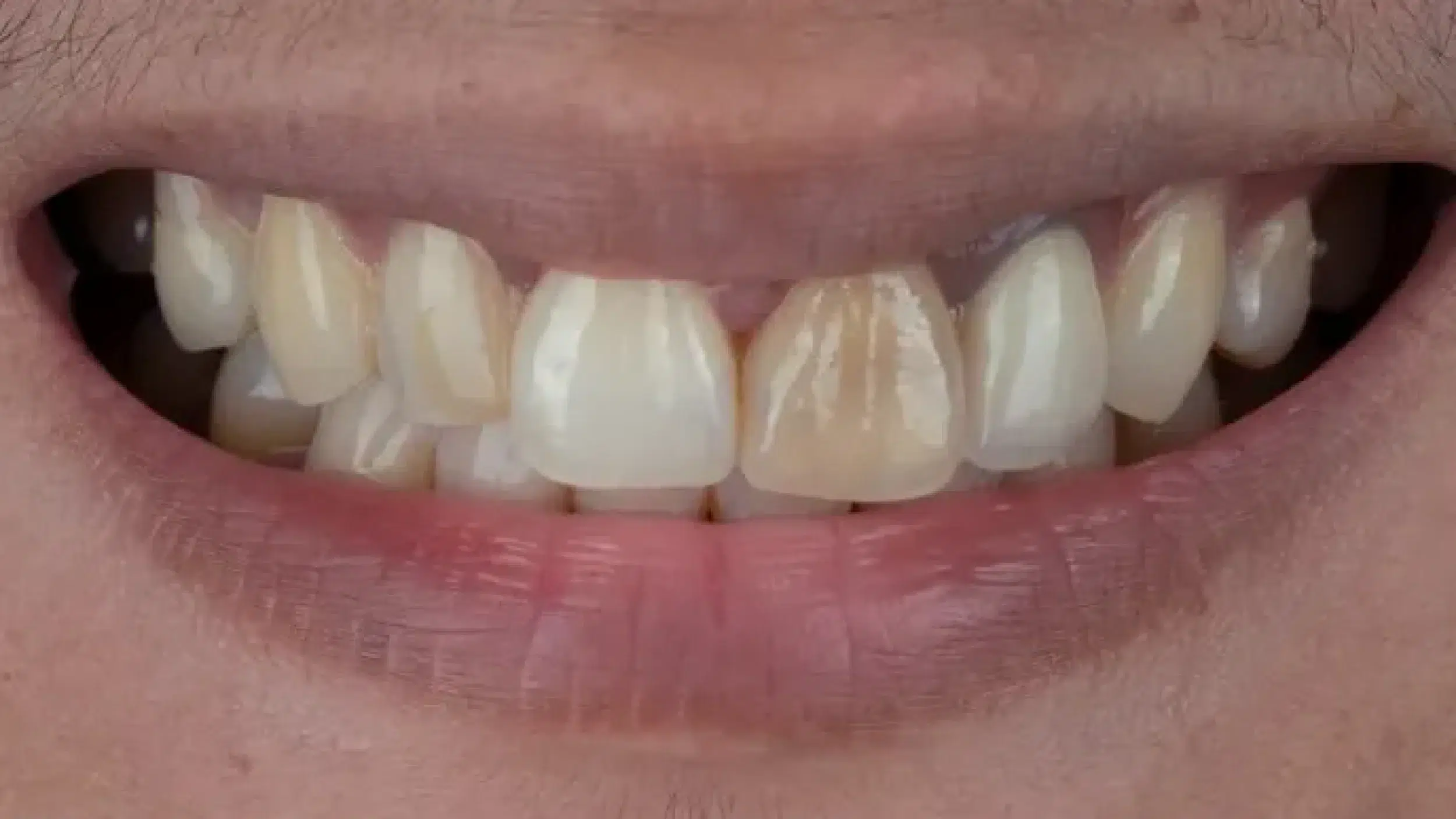 Before-Veneers-New-1 Before-Veneers-New-1