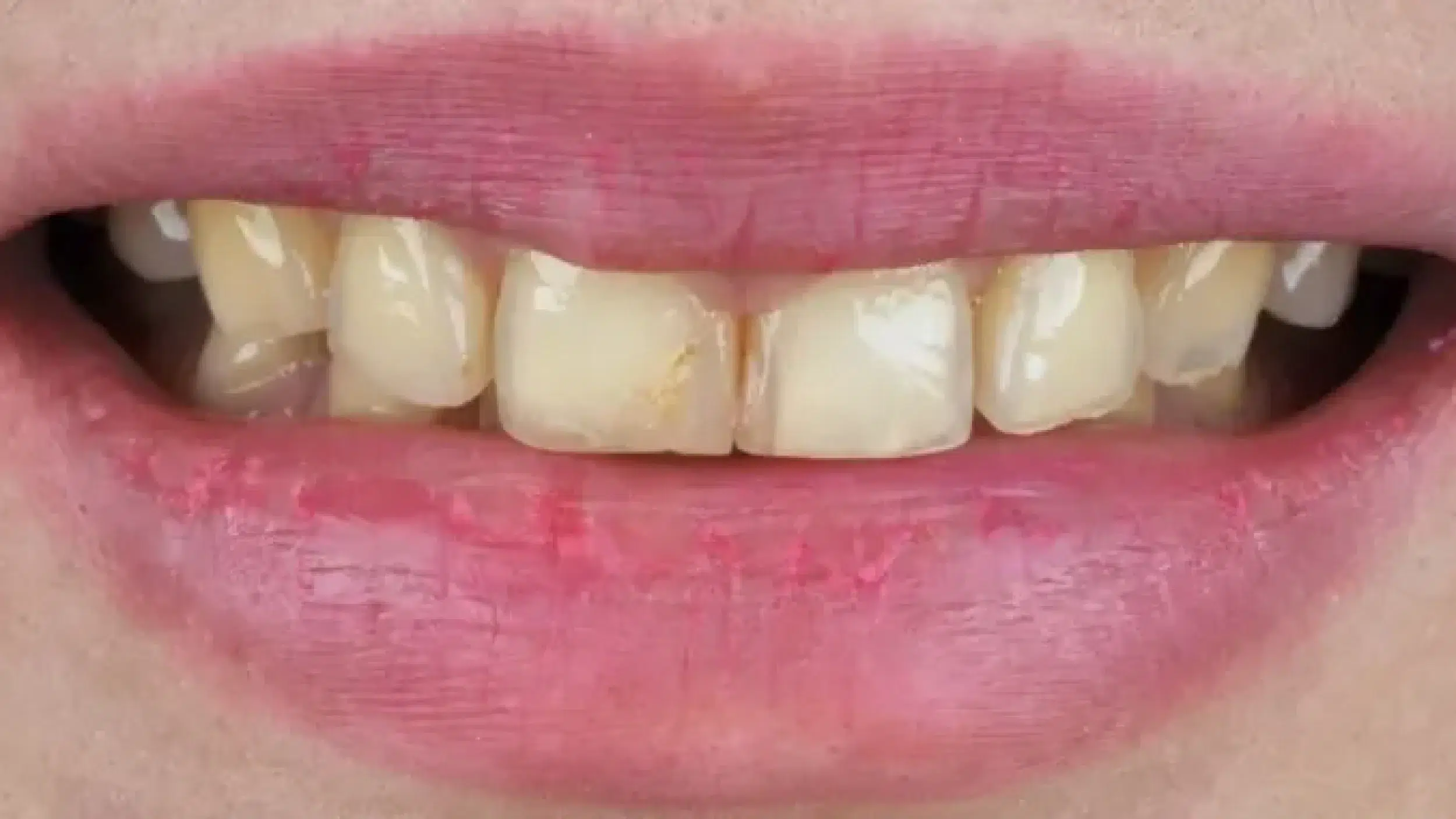 Before-Veneers-New-2 Before-Veneers-New-2