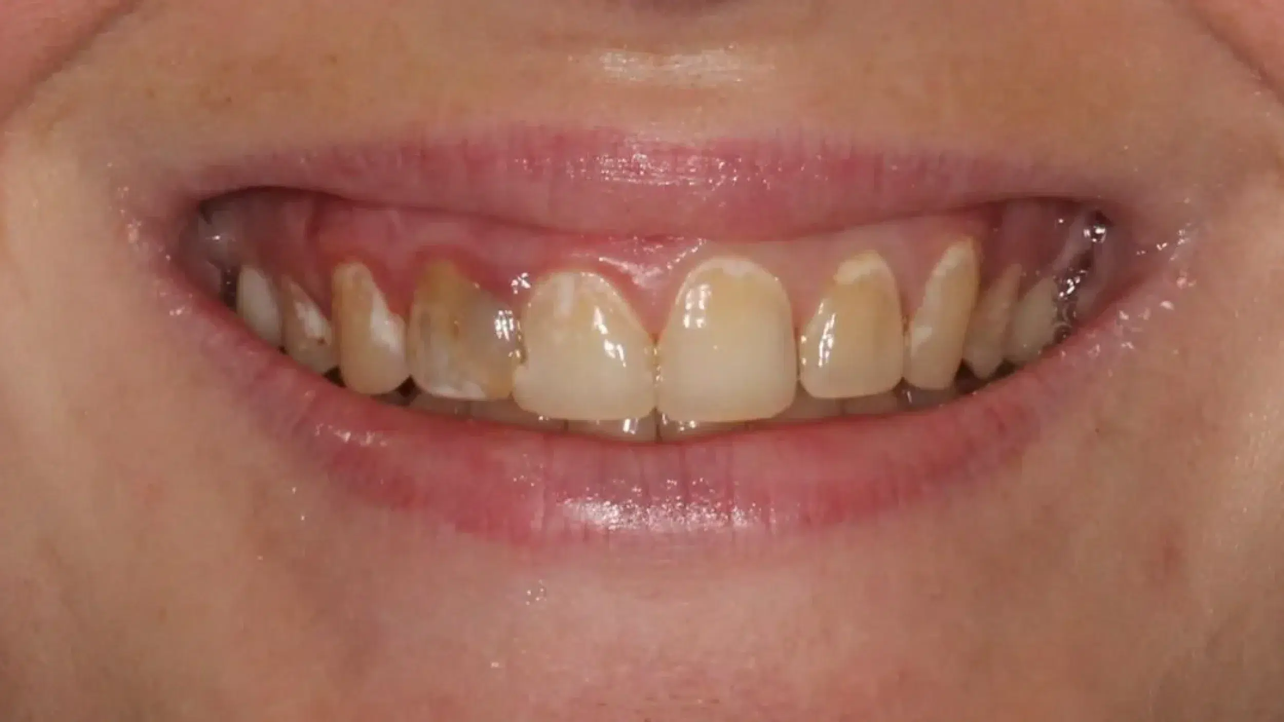 Before-Veneers-New-3 Before-Veneers-New-3