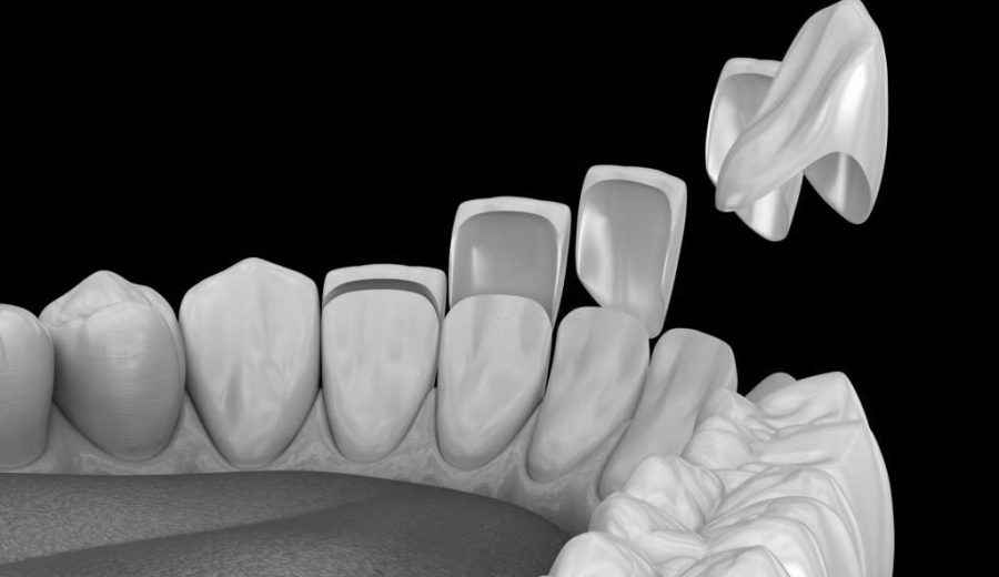 Veneer installation procedure over central incisor and lateral incisors. Medically accurate tooth 3D illustration